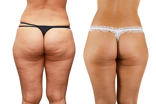 Before And After Endermologie 1